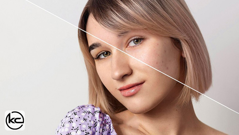 5 بهترین سرم ضد لک خفن در بازار